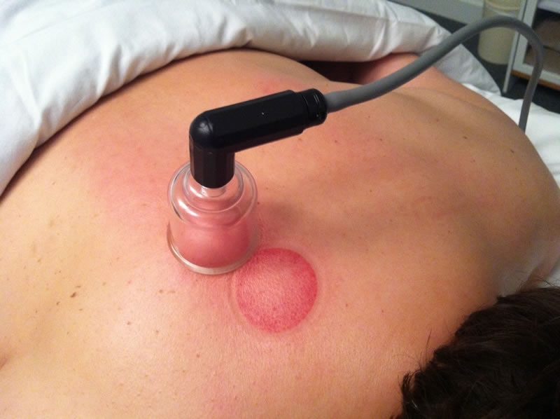 cupping9