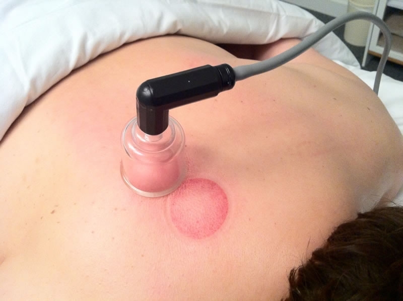 cupping_3